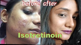 My acne story and Accutane Isotretinoin  How I cleared hormonal acne [upl. by Handbook]