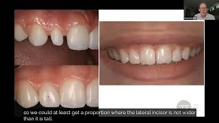 Peg Lateral Restoration Treatment Planning  Dental Online Training [upl. by Brighton]