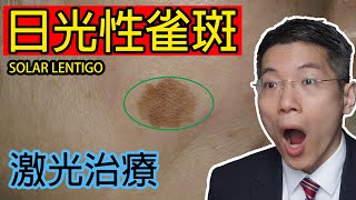 日光性雀斑  激光治療  solar lentigo  laser treatment  皮膚專科  Dermatologist [upl. by Nelluc]