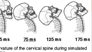 How your body gets damaged in a whiplash injury [upl. by Valer]