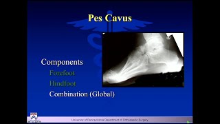 The Cavus Foot A Deformity That May Need Treatment amp What I Do amp When I Do It  Keith L Wapner MD [upl. by Arch]