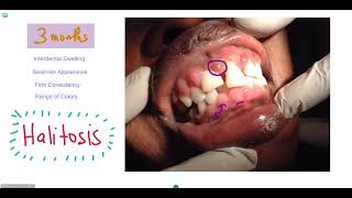 DrugInduced Gingival Enlargement [upl. by Adirem]