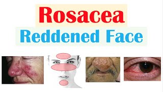 Rosacea Red Lesions on Face  Causes Triggers Types Signs amp Symptoms Diagnosis Treatment [upl. by Panter]