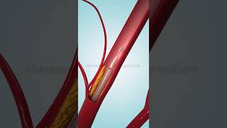 Coronary Angioplasty and Stent Insertion [upl. by Nylorahs]