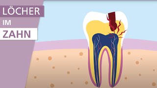 Was ist Karies  Stiftung Gesundheitswissen [upl. by Babb]
