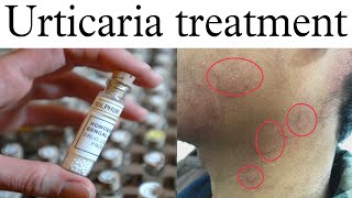 Urticaria Homeopathy Treatment  Pitti Uchalne Par Kiya Karte Hain  Urticaria Treatment In Hindi [upl. by Furey205]