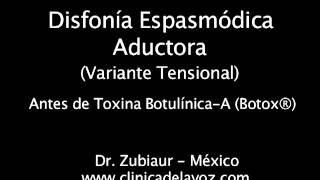 Disfonía Espasmódica Variante Tensional pre y post Botox® [upl. by Boylan]