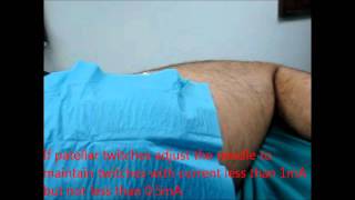 posterior lumbar plexus block nerve stimulationwmv [upl. by Treb252]