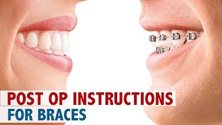 Post Op Instructions For Braces [upl. by Adleme]