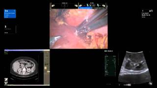 BK Medical Robotic Assisted Partial Nephrectomy RAPN by Dr James R Porter [upl. by Bogie699]