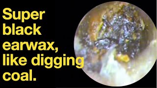 Super black earwax like digging coal ear wax removal  ear cleaning  ASMR  relaxation  relax [upl. by Bravin]