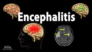 Encephalitis Animation [upl. by Olatha]