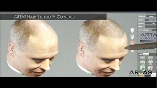 Watch an ARTAS Robotic FUE Hair Transplant  We Grow Hair Indy VIP Kevin Bowen Day of Procedure [upl. by Hinkle124]