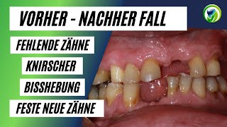 Patient bekommt neues Lebensgefühl mit neuen schönen Zähnen  Implantaten KronenBrücken IOS [upl. by Anewor]