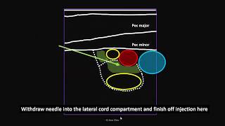 How To Ultrasound Guided Saphenous Nerve Block 3D Video [upl. by Bael]