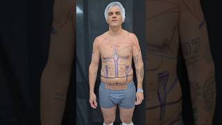 renuvion abdominoplastia lipohd lipovaser grasaabdiminal sixpack [upl. by Klute]