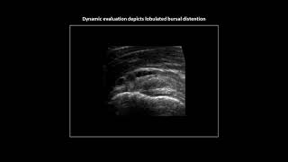 Lobulated subacromialsubdeltoid bursitis on shoulder ultrasound [upl. by Illehs]