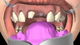 How to use Dental Impression trays  GDC Perforated and Non Perforated impression trays MyDentCart [upl. by Yro368]