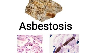 Asbestosis pneumoconiosis [upl. by Farny]