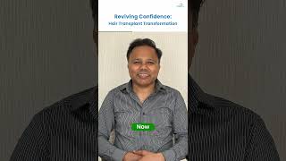 Mr Suman Pandey Got a Hair Transplant Shocking Results Revealedhairtransformation hairloss [upl. by Aivilo]