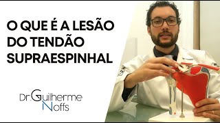 Lesão do Tendão Supraespinhal  Dr Guilherme Noffs [upl. by Gatian]