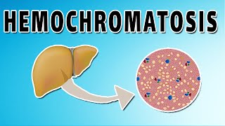 Hemochromatosis [upl. by Aronle598]