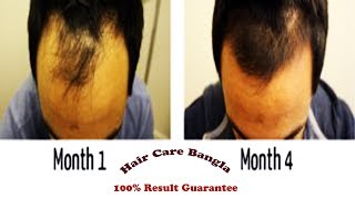 Homeopathic Medicine For Alopecia and Baldness  Hair Care Bangla [upl. by Castorina831]