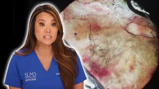 Parasitenbefall  Dr Pimple Popper  TLC Deutschland [upl. by Ellehcin]