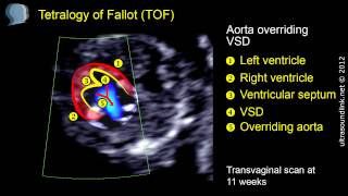 Tetralogy of Fallot TOF echo at 11 weeks [upl. by Esyak]