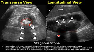 Kidney Ultrasound Reporting  Renal Diseases Scan Reports  How To Write USG Report  KUB USG [upl. by Neurath]