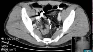 Crohns Stenosis with Video Capsule Retention amp Removal by Peranal SingleBalloon Enteroscopy [upl. by Zelikow]