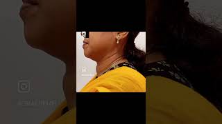 Large thyroid goitre treatment by Radiofrequency ablation RFA [upl. by Noni747]