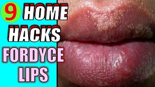 How to Get Rid of Fordyce Spots at Home Quickly  9 Home Remedies for Fordyce Spots on Lips [upl. by Lelith]