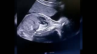 Sacrococcygeal teratoma in pregnancy ultrasound [upl. by Anirtruc]