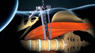 LLIF Lateral Lumbar Interbody Fusion  Larry Parker MD [upl. by Stargell846]