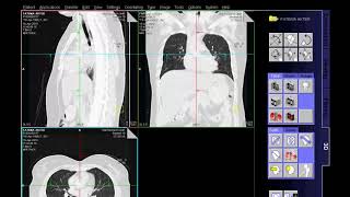 HRCT Scan Chest Techniq amp Filming [upl. by Rothwell]