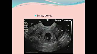 Bleeding in early pregnancy part 2Ectopic pregnancy [upl. by Tiffani859]