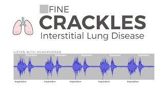 Fine Velcro Crackles [upl. by Onidranreb]