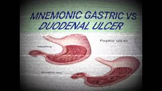 MNEMONIC GASTRIC ULCER VS DUODENAL ULCERmedicinelectures medicineeducationtalks medilectures [upl. by Amaso]