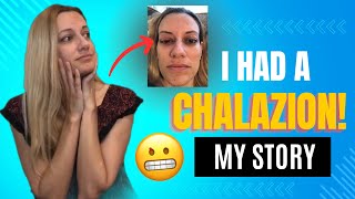 CHALAZION Symptoms Treatment Risk Factors Recovery My Story [upl. by Aserej]