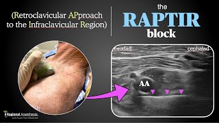 RAPTIR block Retroclavicular Approach to the Infraclavicular Region [upl. by Piselli462]