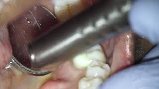 Fotona Lightwalker Laser Ceramic Crown Removal [upl. by Ynafetse]