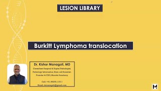 Pathology of Burkitt Lymphoma Translocation [upl. by Yblek]