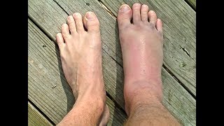 SPRAINED or BROKEN Ankle  Doctor Guide [upl. by Clute]