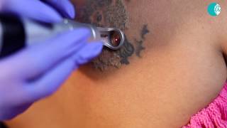 Safe and Quick Laser Tattoo Removal Treatment [upl. by Yenruoj]