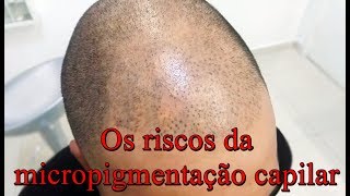 Antes de fazer uma Micropigmentação capilar veja este vídeo [upl. by Hillard]