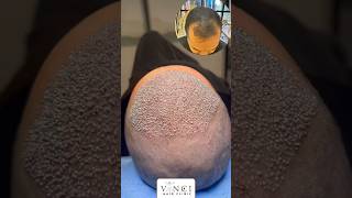 Hair transplant post op for a Norwood 3 without crown hairloss vincihairclinic shorts [upl. by Eigger]