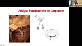 M RADERMECKER Rech transversale s la dégénérescence myxoïde de la valve mitrale amp chirurgie [upl. by Berlinda95]