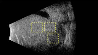 Spontaneous Vascular Pulsations Within Intraocular Mass [upl. by Jasen]