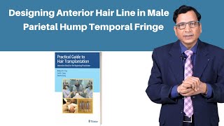 Designing Anterior Hair Line in Male  Temporal Fringe  Parietal Hump [upl. by Kuster]